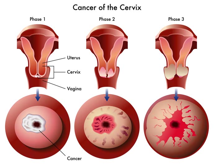 4_cervical_cancer